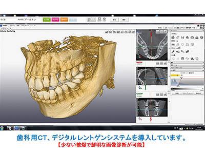 歯科用CT　デジタルレントゲン